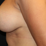Breast Augmentation - Shaped Silicone Implants Before & After Patient #29439