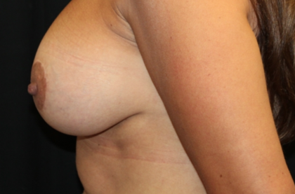 Breast Augmentation - Shaped Silicone Implants Before & After Patient #29439