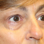 Blepharoplasty Before & After Patient #29451