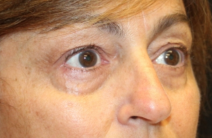 Blepharoplasty Before & After Patient #29451