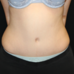 Tummy Tuck Before & After Patient #29475