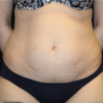 Tummy Tuck Before & After Patient #29475