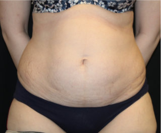 Tummy Tuck Before & After Patient #29475