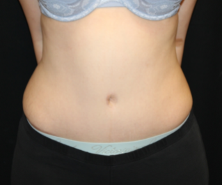 Tummy Tuck Before & After Patient #29475