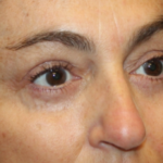 Blepharoplasty Before & After Patient #29451