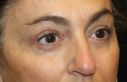 Blepharoplasty Before & After Patient #29451