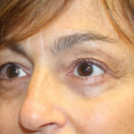 Blepharoplasty Before & After Patient #29451