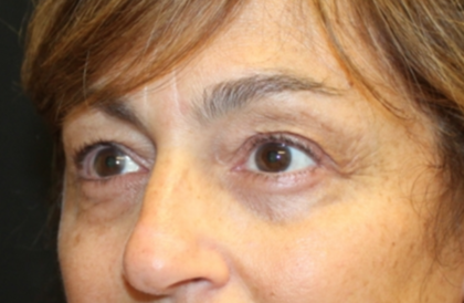 Blepharoplasty Before & After Patient #29451