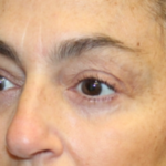 Blepharoplasty Before & After Patient #29451