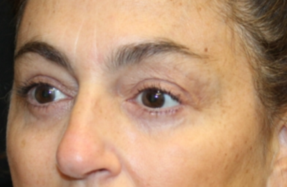 Blepharoplasty Before & After Patient #29451