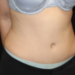 Tummy Tuck Before & After Patient #29475