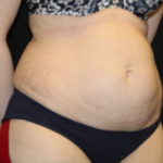 Tummy Tuck Before & After Patient #29475