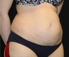 Tummy Tuck Before & After Patient #29475