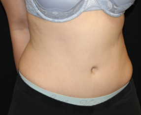 Tummy Tuck Before & After Patient #29475