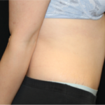 Tummy Tuck Before & After Patient #29475