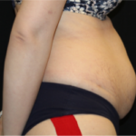 Tummy Tuck Before & After Patient #29475