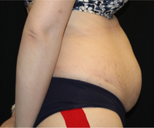 Tummy Tuck Before & After Patient #29475