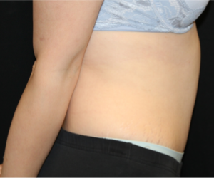 Tummy Tuck Before & After Patient #29475