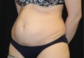 Tummy Tuck Before & After Patient #29475