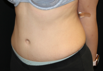 Tummy Tuck Before & After Patient #29475