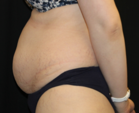 Tummy Tuck Before & After Patient #29475