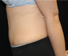 Tummy Tuck Before & After Patient #29475