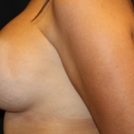 Breast Implant Exchange Before & After Patient #29598