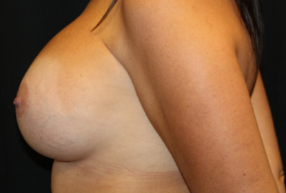 Breast Implant Exchange Before & After Patient #29598