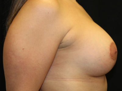 Breast Implant Exchange Before & After Patient #29587