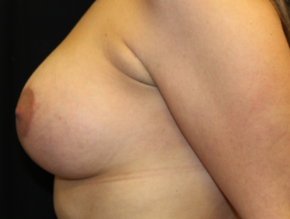 Breast Implant Exchange Before & After Patient #29587