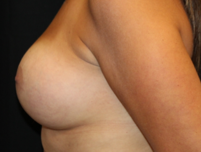 Breast Implant Exchange Before & After Patient #29587