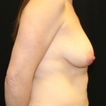 Tummy Tuck Before & After Patient #29773