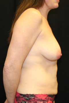 Tummy Tuck Before & After Patient #29773