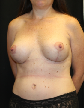 Tummy Tuck Before & After Patient #29773