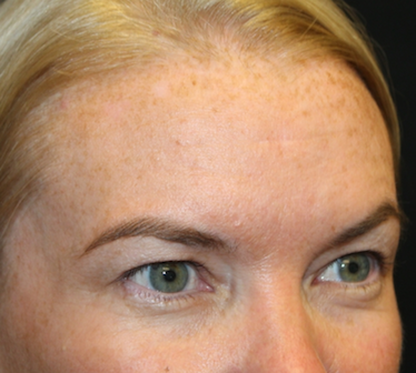 Brow Lift Before & After Patient #29694