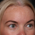 Brow Lift Before & After Patient #29694