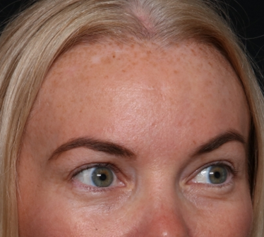 Brow Lift Before & After Patient #29694