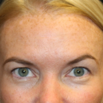 Brow Lift Before & After Patient #29694