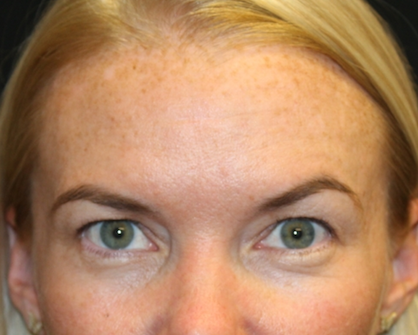 Brow Lift Before & After Patient #29694