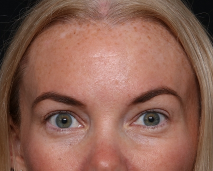 Brow Lift Before & After Patient #29694