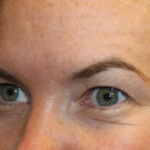 Brow Lift Before & After Patient #29694