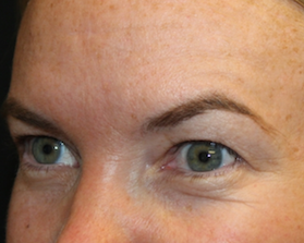 Brow Lift Before & After Patient #29694