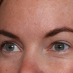 Brow Lift Before & After Patient #29694