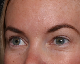 Brow Lift Before & After Patient #29694