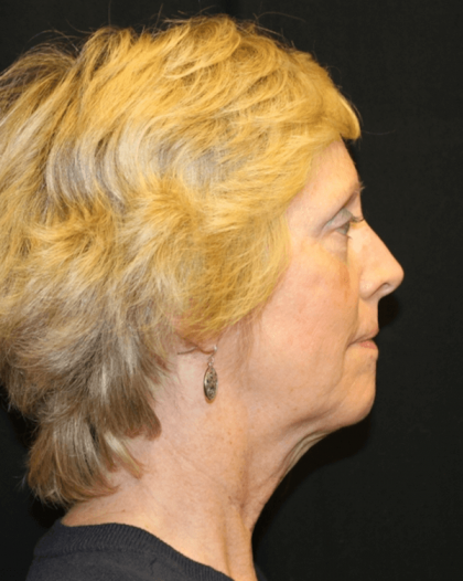 Facelift Before & After Patient #29620
