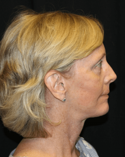 Facelift Before & After Patient #29620