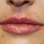 Lip Filler Before & After Patient #29765