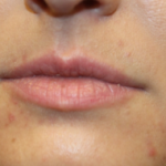 Lip Filler Before & After Patient #29765