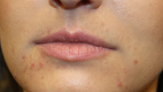 Lip Filler Before & After Patient #29765