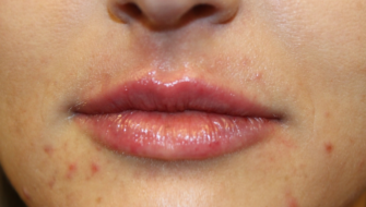 Lip Filler Before & After Patient #29765